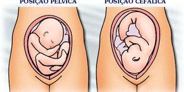 imagem pelvico cefalico